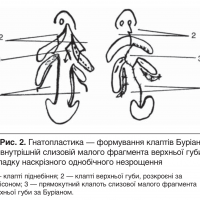 Порівняльна характеристика методів хірургічного лікування незрощень верхньої губи та піднебіння в дітей різного віку  - Ч.3